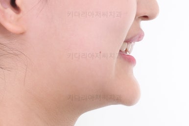 부산옥니교정