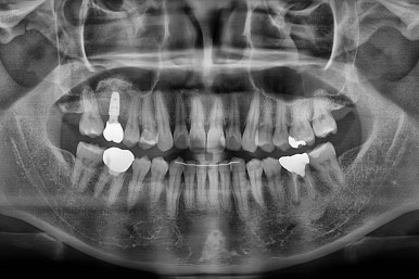 부산치아교정비용