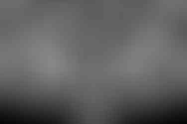 부산치아교정비용