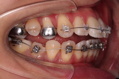 부산치아교정잘하는치과