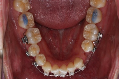 부산비수술교정