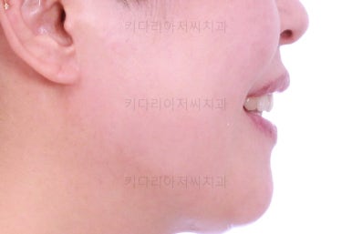 동래임플란트교정