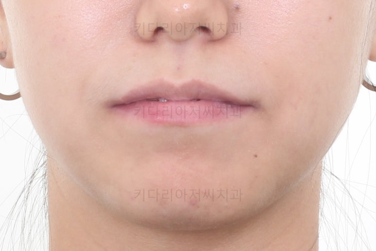 부산교정잘하는치과