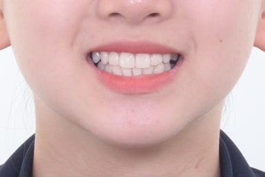 부산치아교정잘하는곳