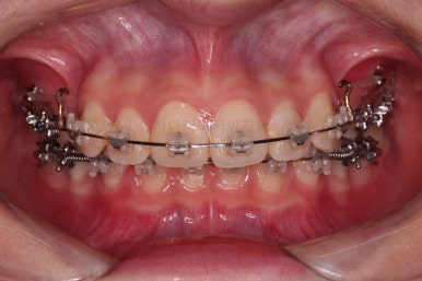 연산동치아교정