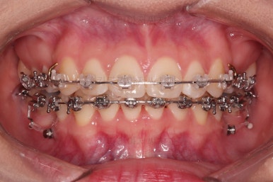 연산동치아교정치과