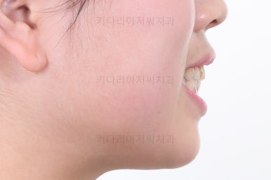 부산비발치교정