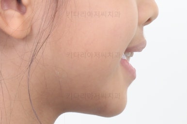 부산어린이반대교합