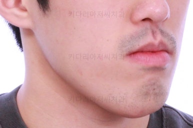 부산긴얼굴긴턱교정