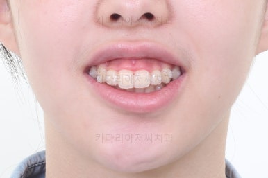 부산투명교정