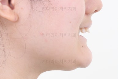 연산동치아교정