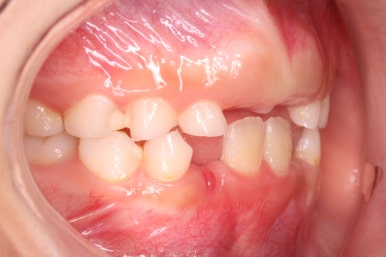부산어린이치아교정