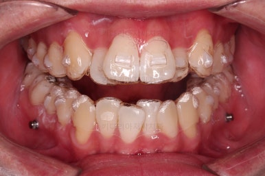 부산인비절라인