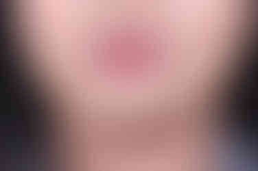 부산사각턱보톡스