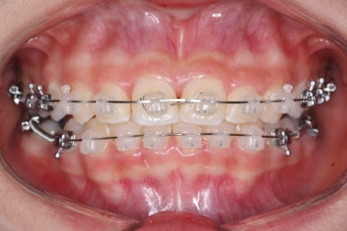 부산치아교정잘하는곳