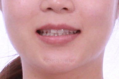 부산치아교정비용