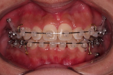 부산청소년치아교정