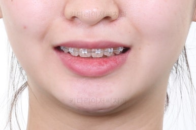 부산돌출입교정