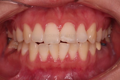 부산사랑니교정