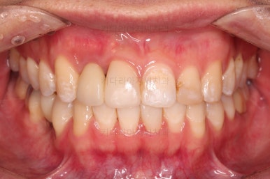 연산동치아교정