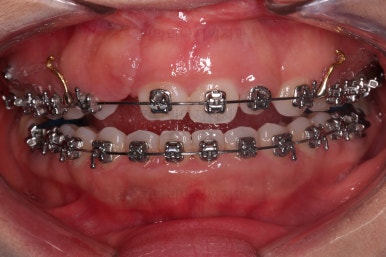 부산구순구개열