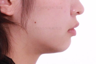 부산돌출입교정