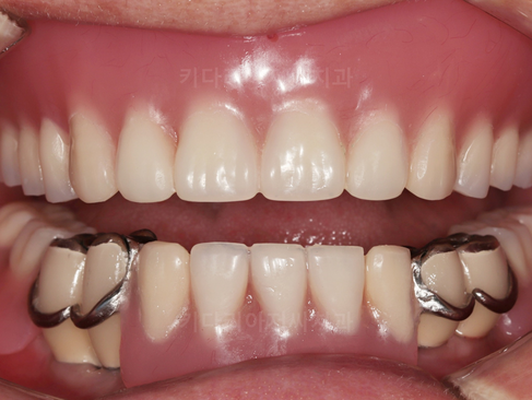 부산보험임플란트