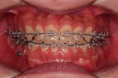 부산주걱턱교정