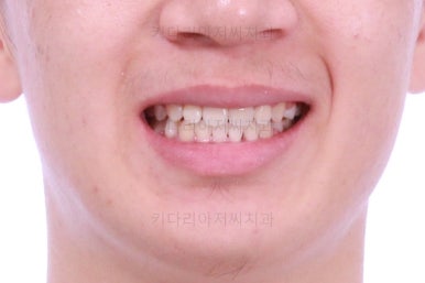 부산청소년치아교정