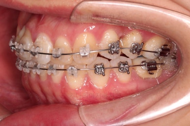 연산동치아교정