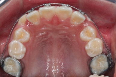 연산동덧니교정