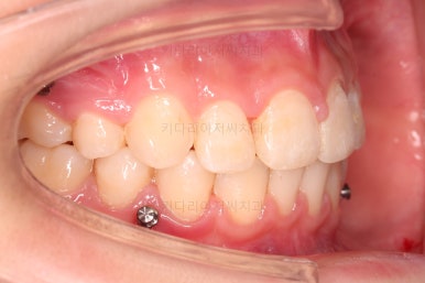 연산동치아교정