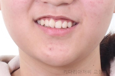 연산동치아교정