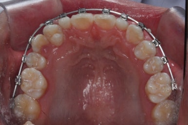 부산왜소치교정