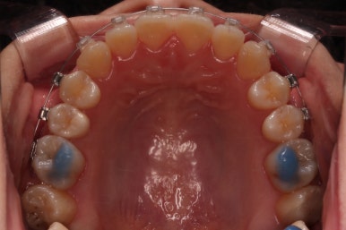 부산치아교정추천