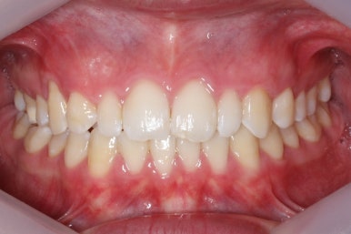 부산왜소치교정