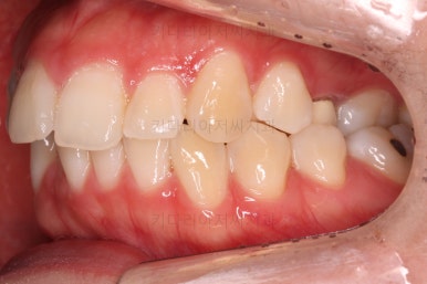 부산비대칭교정