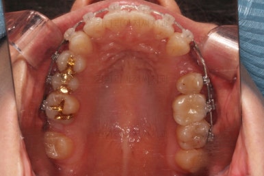 부산사랑니교정