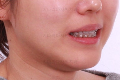 부산치아교정잘하는곳