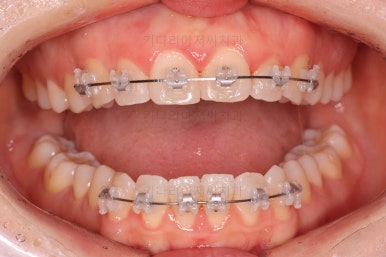 부산나비앞니교정