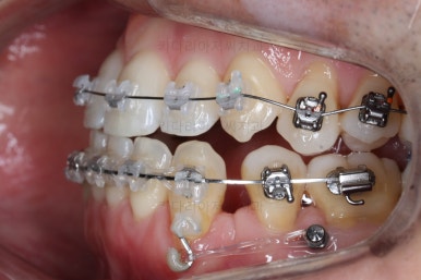 부산비수술교정