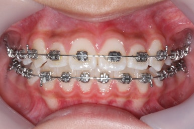 연산동덧니교정