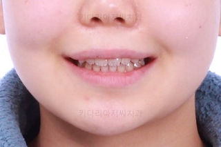 부산앞니벌어짐교정