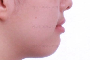 부산투명교정