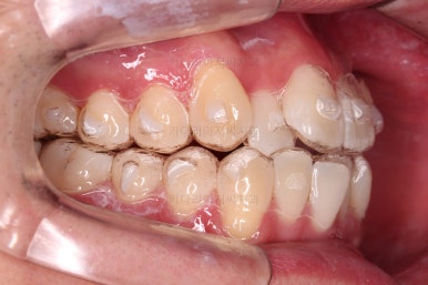 부산인비절라인