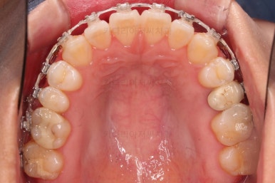 부산치아교정잘하는곳