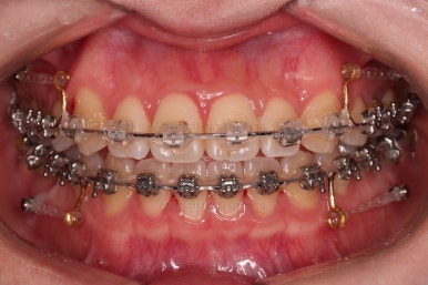 부산치아교정잘하는곳