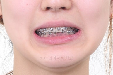 부산안면비대칭