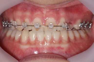 부산매복치아교정