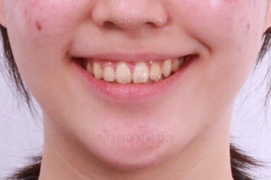 부산비발치교정